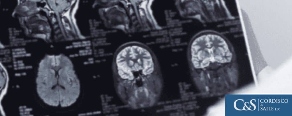 X-ray of a traumatic brain injury